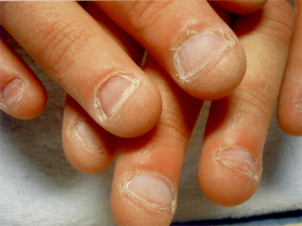 Fingernagel vor der Behandlung