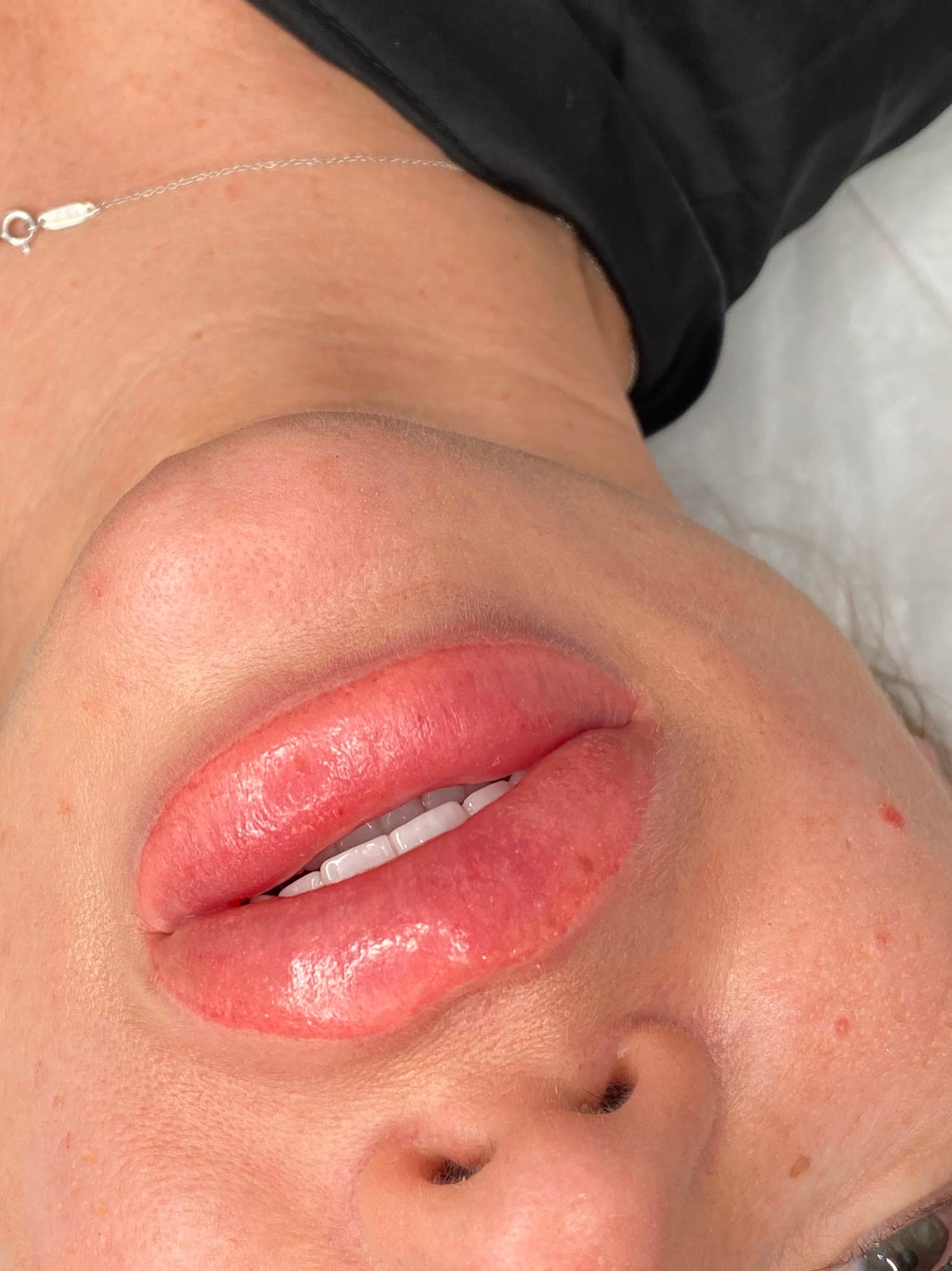 Lippen Ergebnis